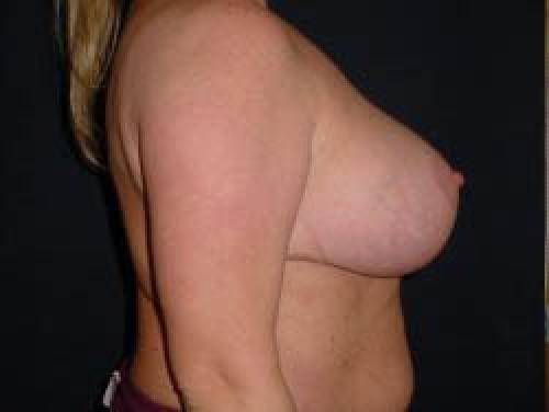 Breast Augmentation with Lift - Patient 6 - After 3