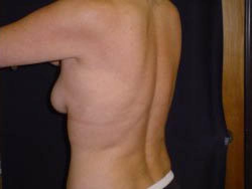Liposuction - Patient 8 -  After 3