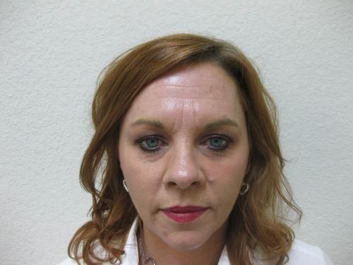 Botox - Patient 3 - After 
