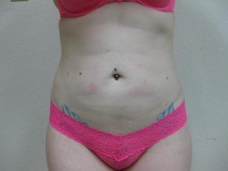 Liposuction - Patient 5 - After 