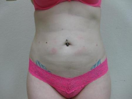 Liposuction - Patient 5 - After Image 1