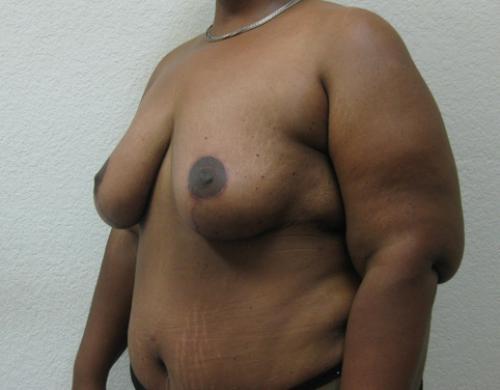 Breast Reduction - Patient 6 -  After 2