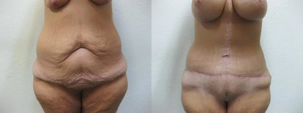 Cosmetic Surgery After Massive Weight Loss - Before and After 4