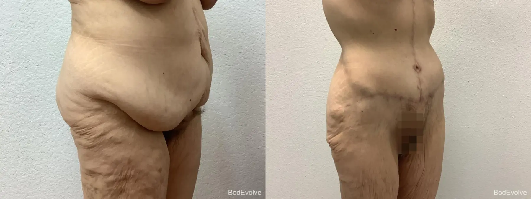 After Massive Weight Loss: Patient 5 - Before and After 4