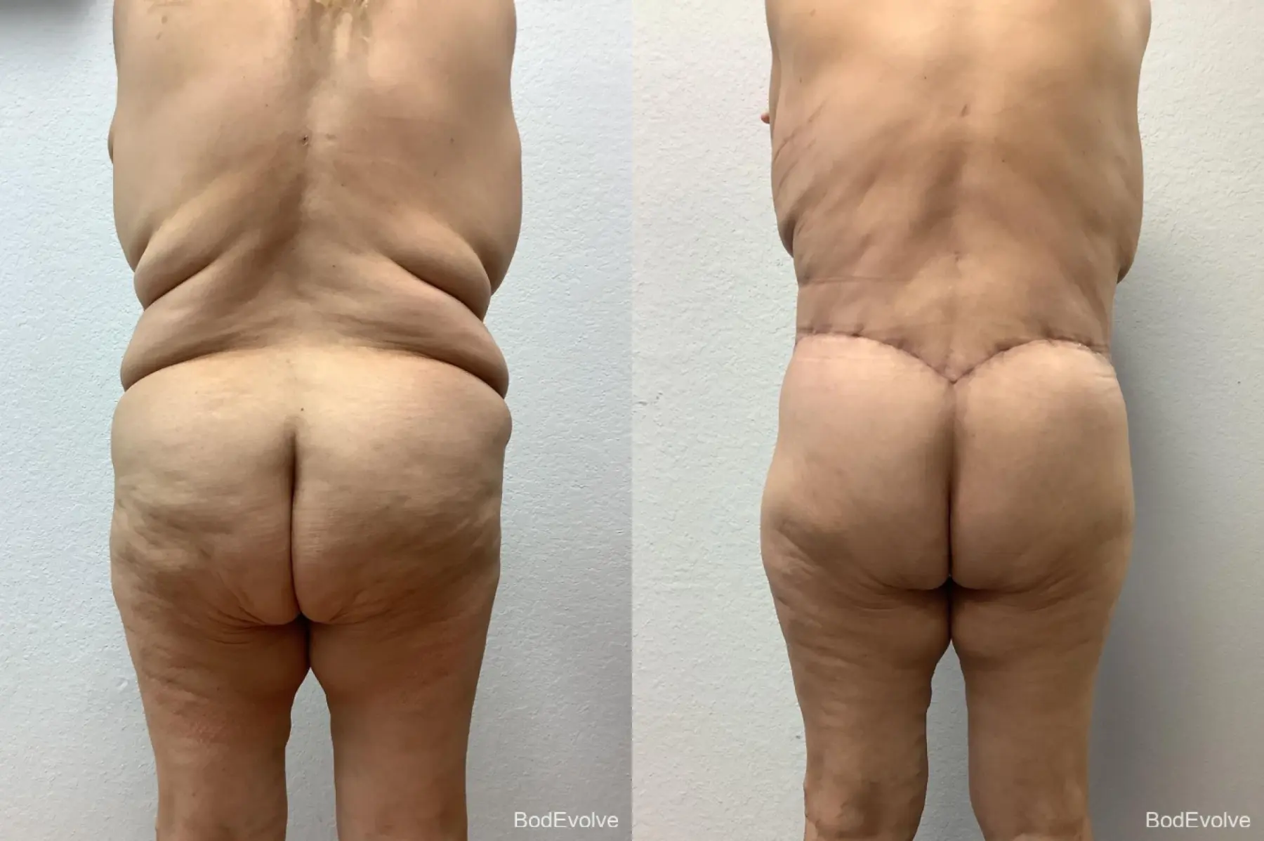 After Massive Weight Loss: Patient 1 - Before and After 6