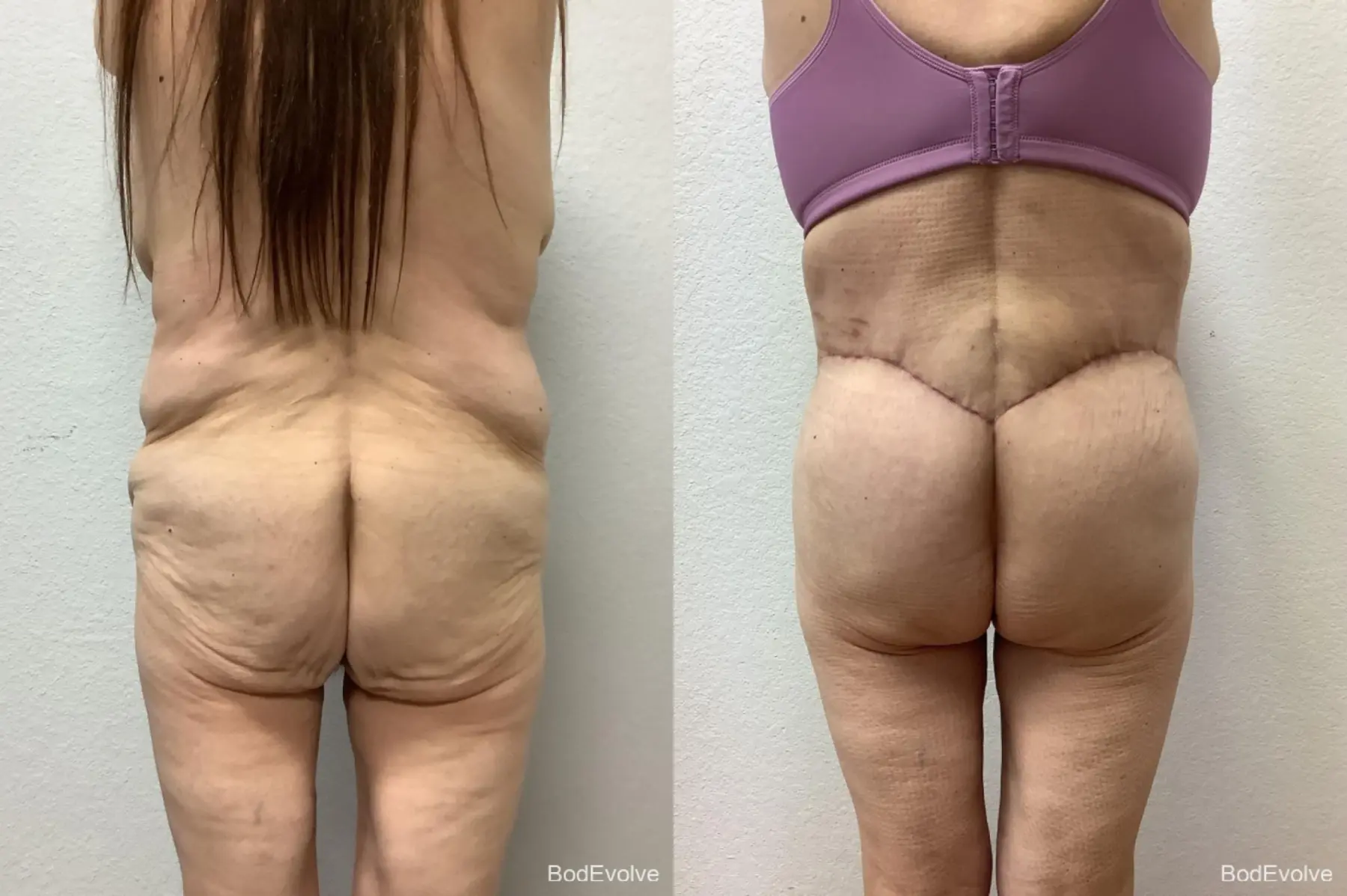 After Massive Weight Loss: Patient 4 - Before and After 6