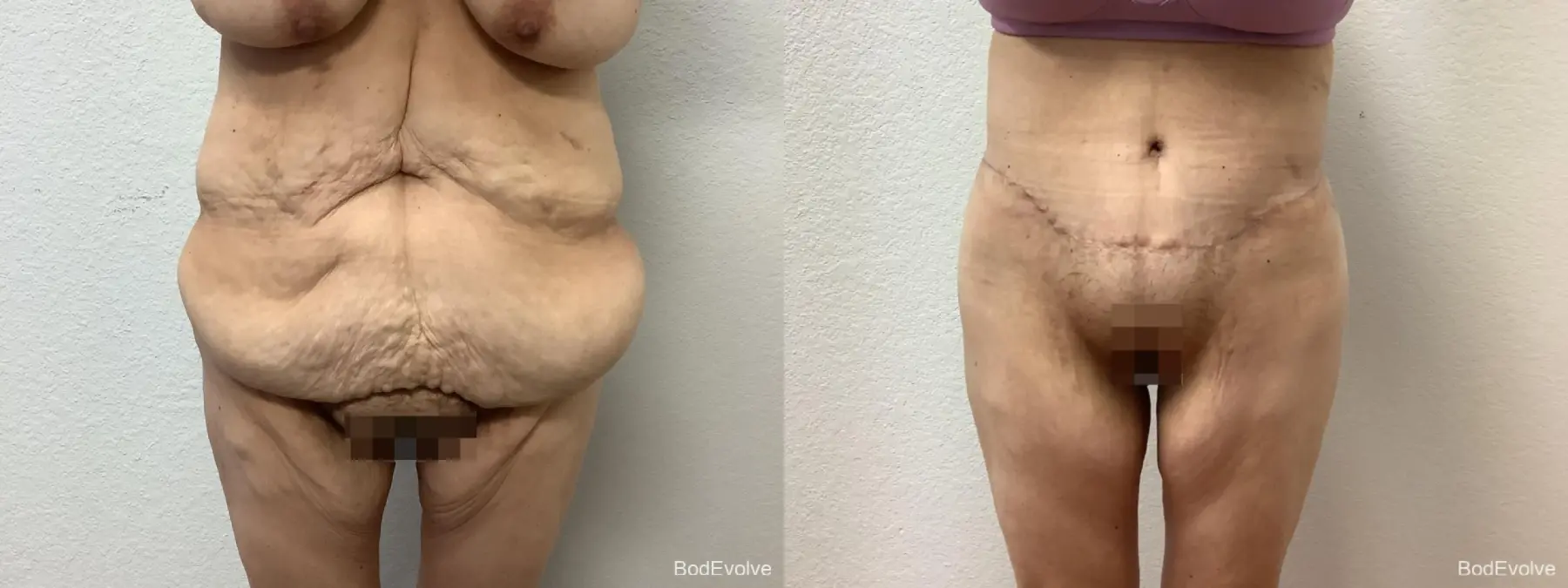 After Massive Weight Loss: Patient 4 - Before and After  