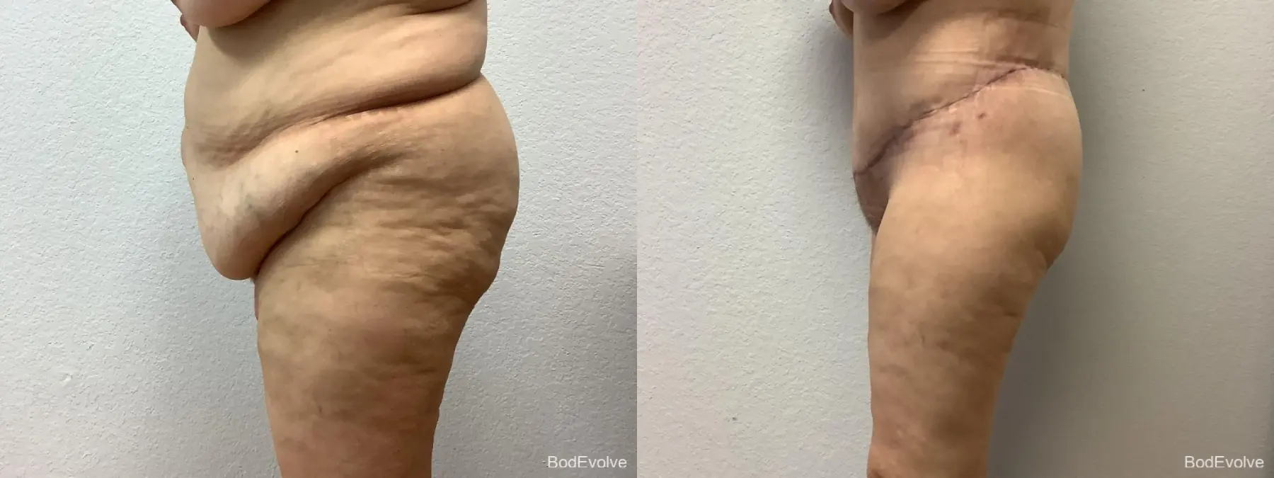 After Massive Weight Loss: Patient 1 - Before and After 3