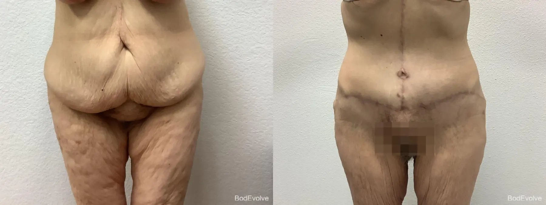After Massive Weight Loss: Patient 3 - Before and After  
