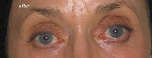 Eyelid Lift - After 