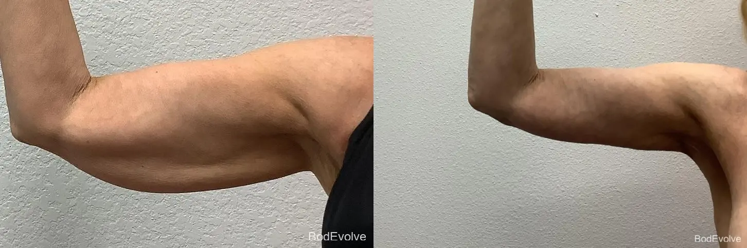 Arm Lift: Patient 7 - Before and After 3