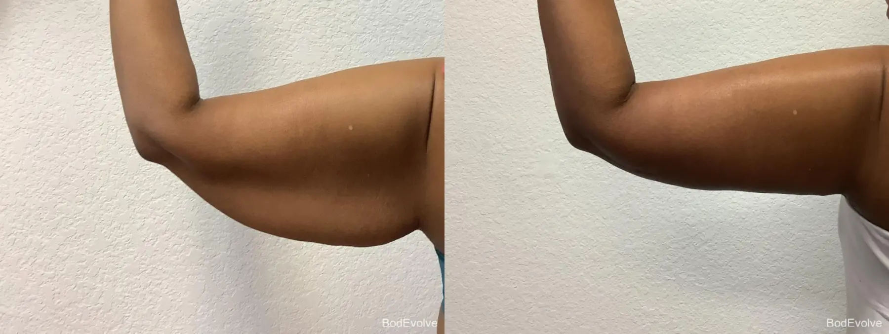 Arm Lift: Patient 2 - Before and After 6