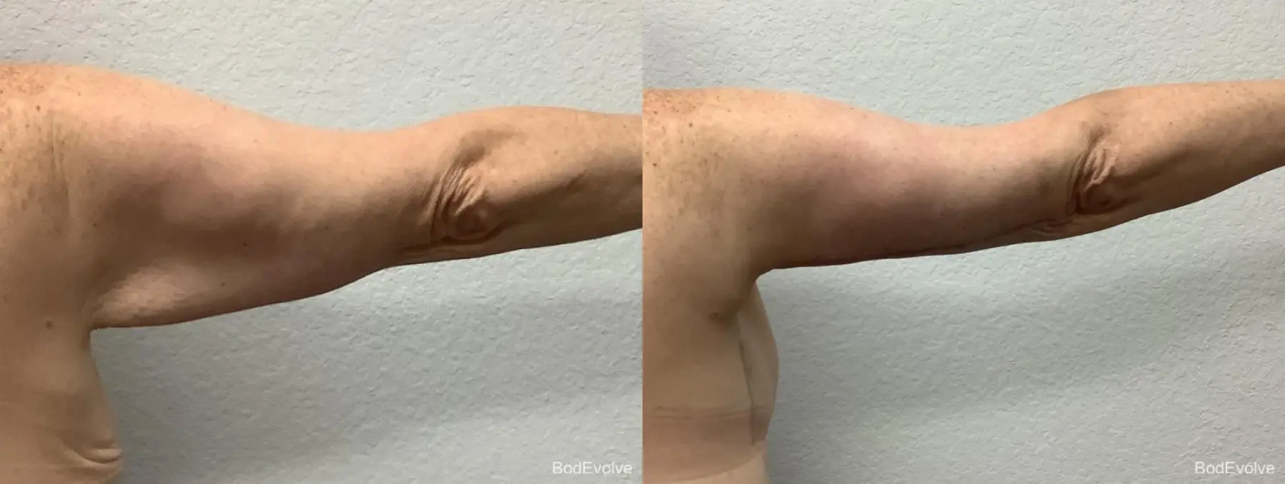 Arm Lift: Patient 6 - Before and After 4