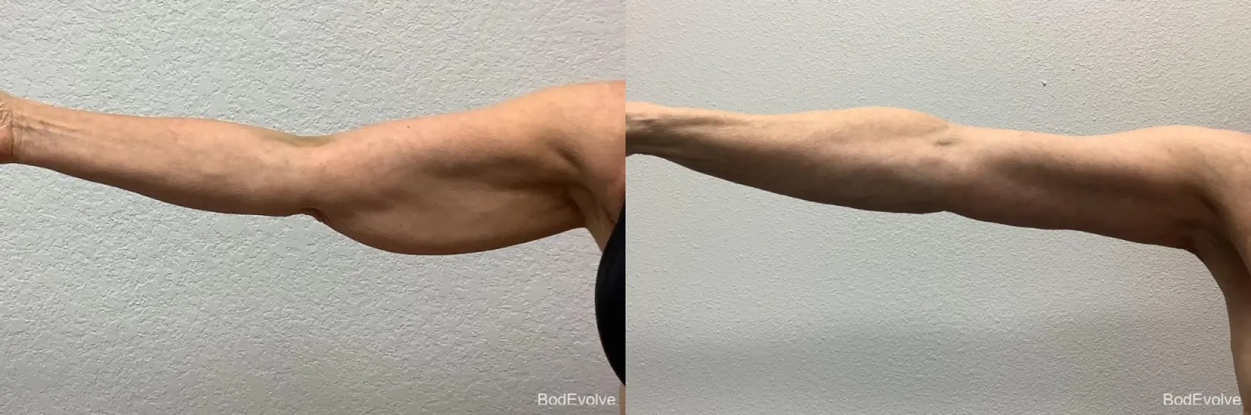 Arm Lift: Patient 1 - Before and After  