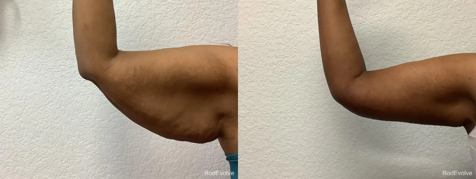 Arm Lift: Patient 2 - Before and After 2