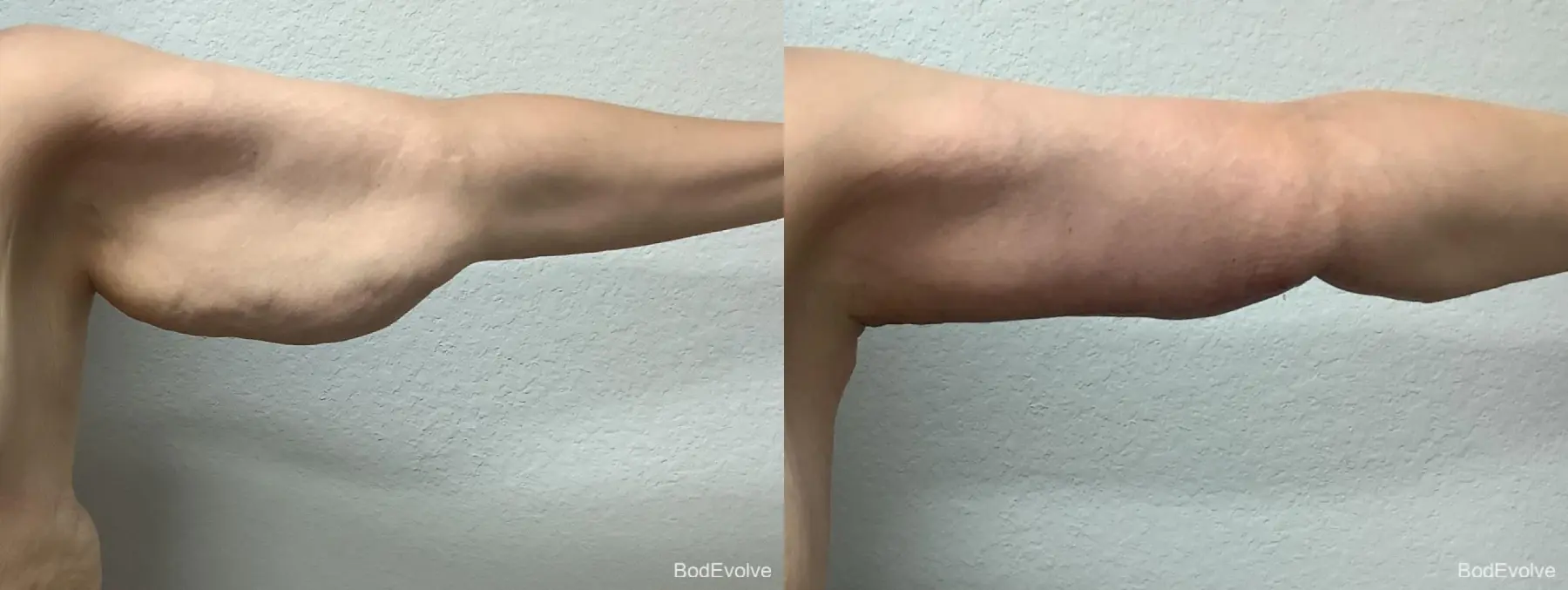 Arm Lift: Patient 1 - Before and After  