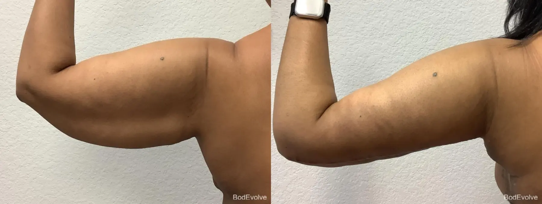 Arm Lift: Patient 5 - Before and After 4