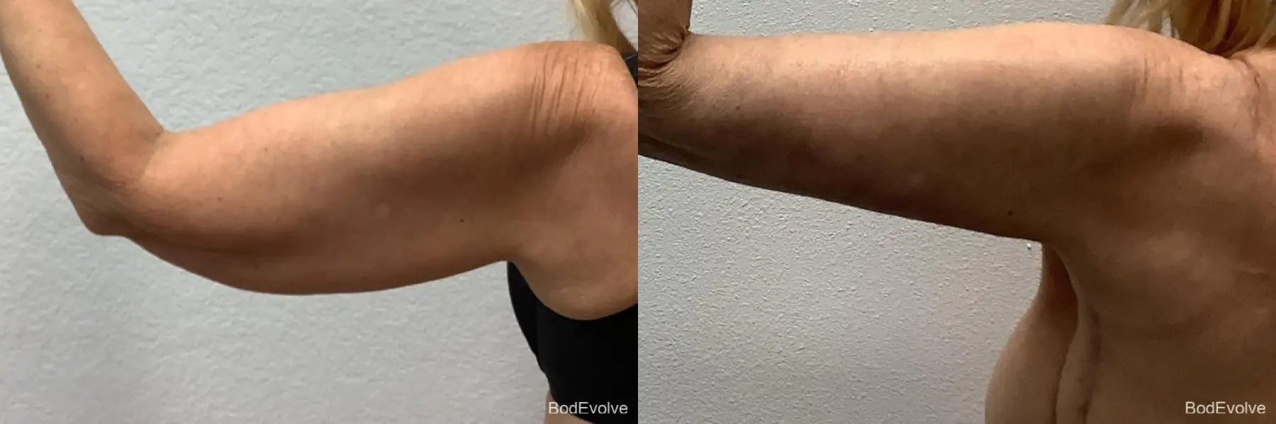 Arm Lift: Patient 7 - Before and After 4