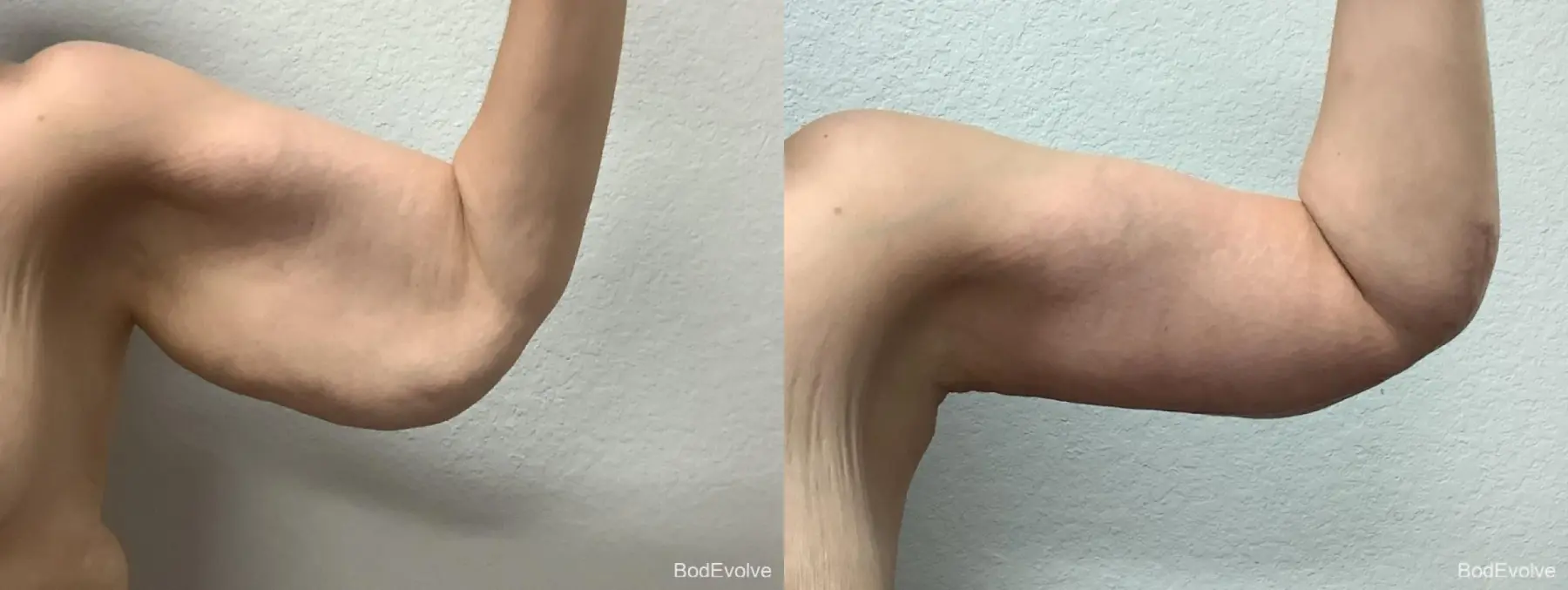 Arm Lift: Patient 1 - Before and After 2