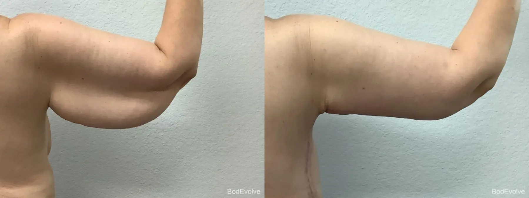 Arm Lift: Patient 1 - Before and After 6