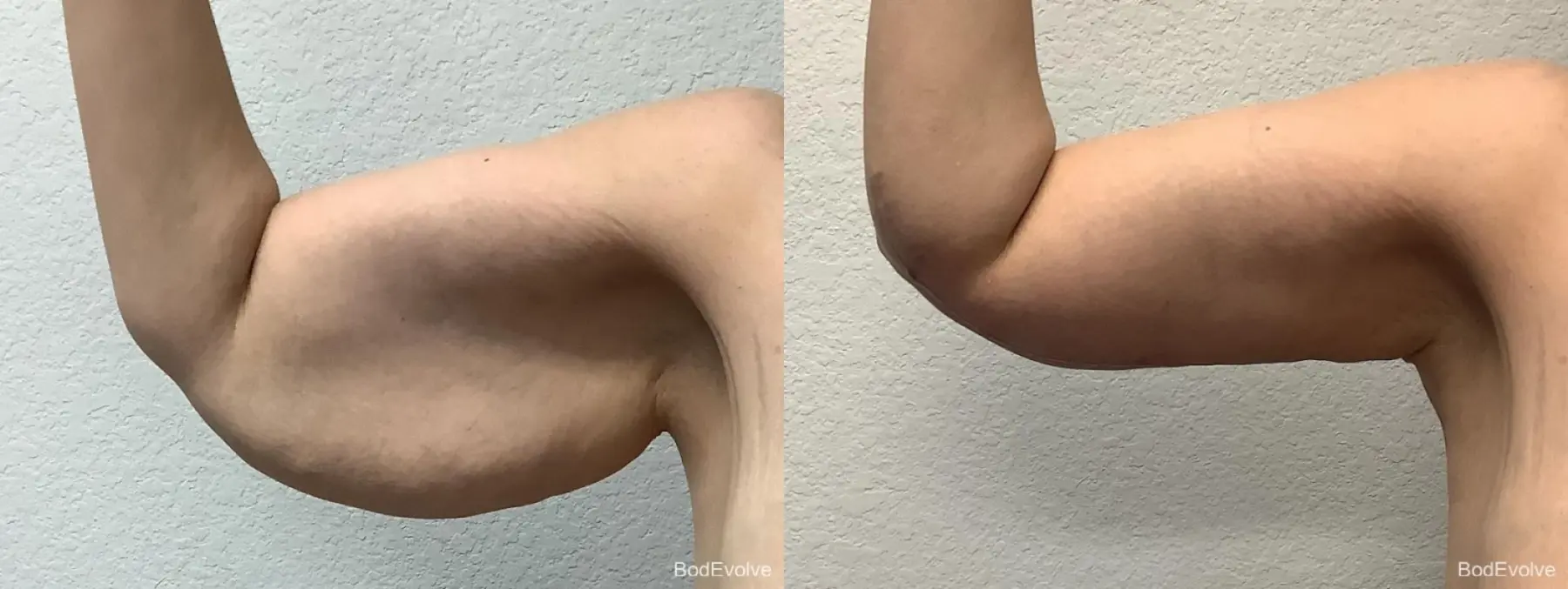 Arm Lift: Patient 1 - Before and After 4