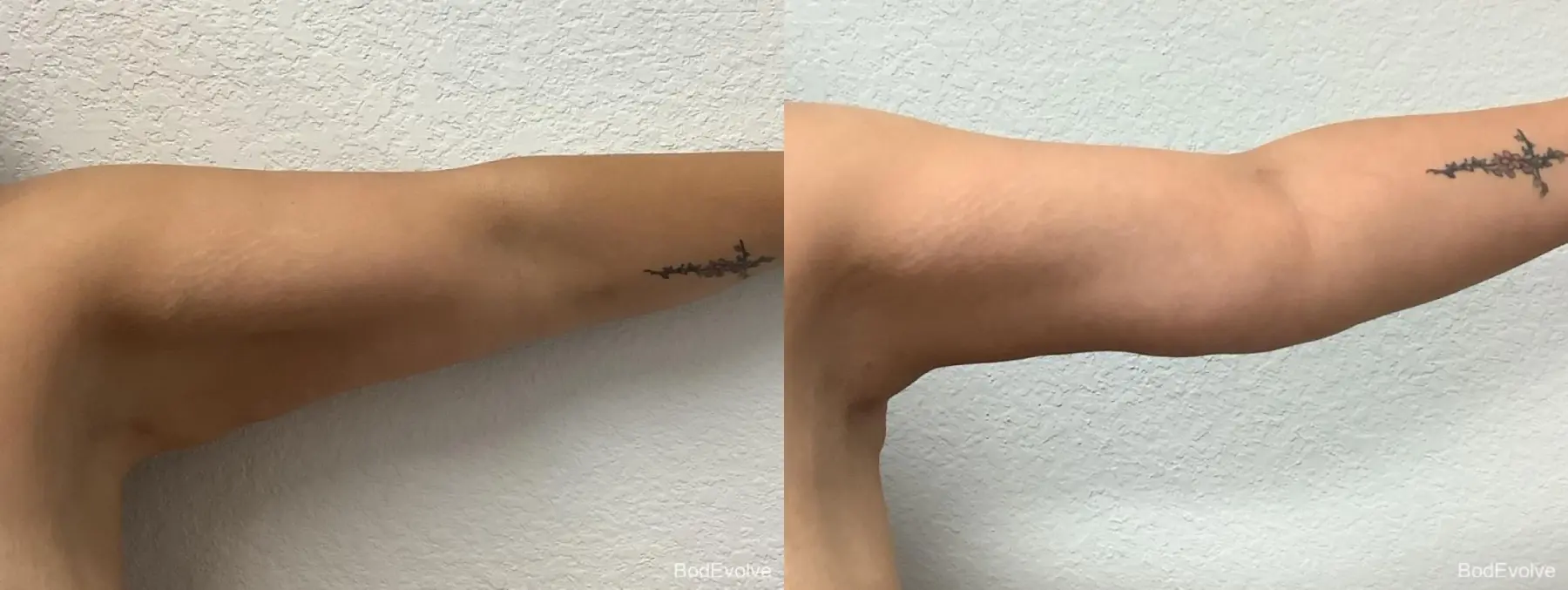 Arm Lift: Patient 4 - Before and After 6