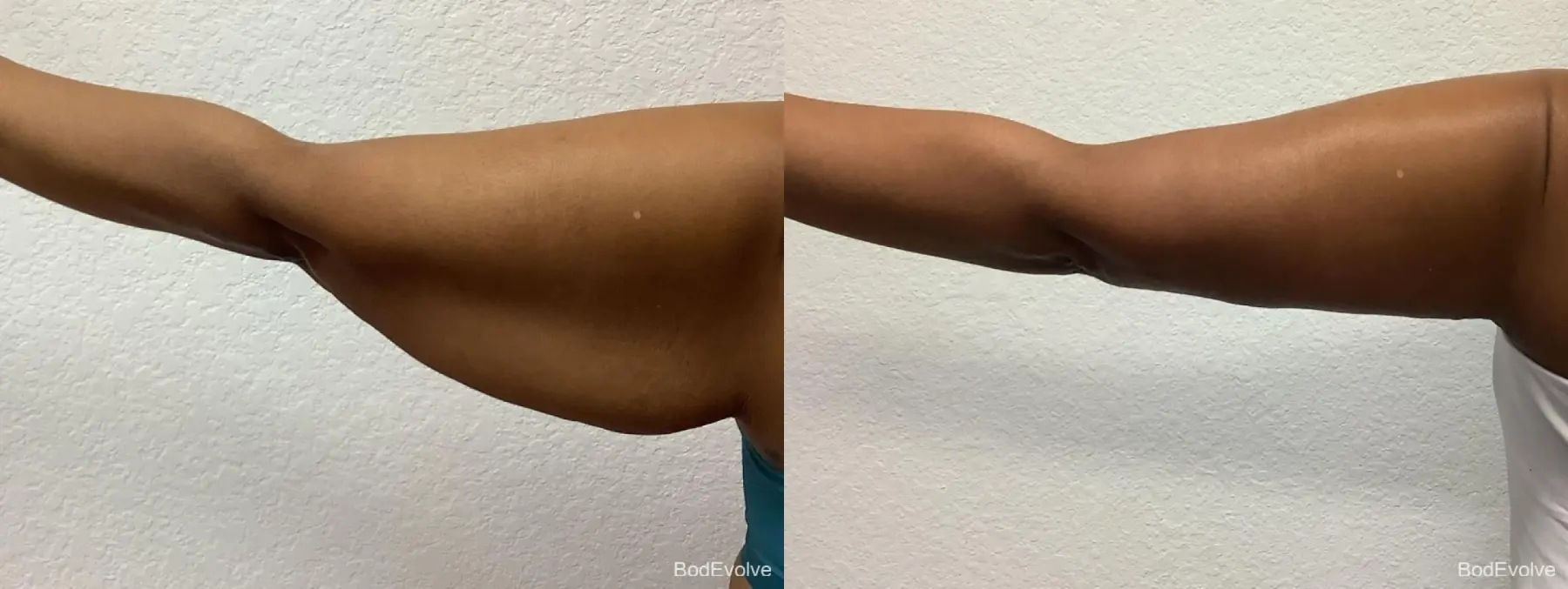 Arm Lift: Patient 2 - Before and After 3