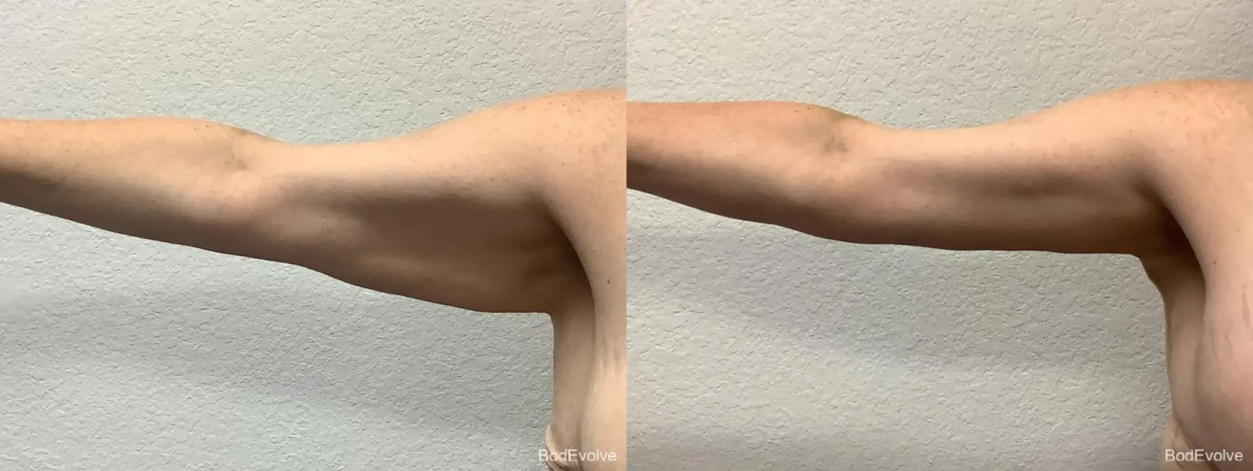 Arm Lift: Patient 6 - Before and After 5