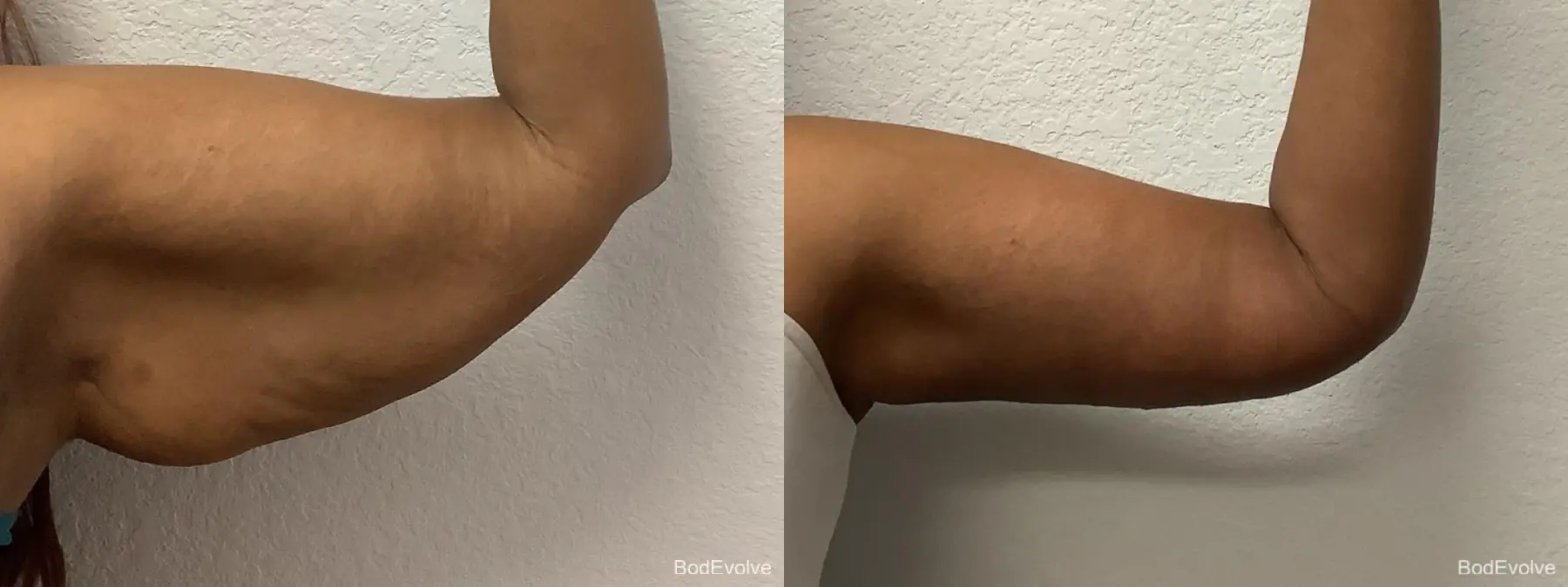 Arm Lift: Patient 2 - Before and After 5