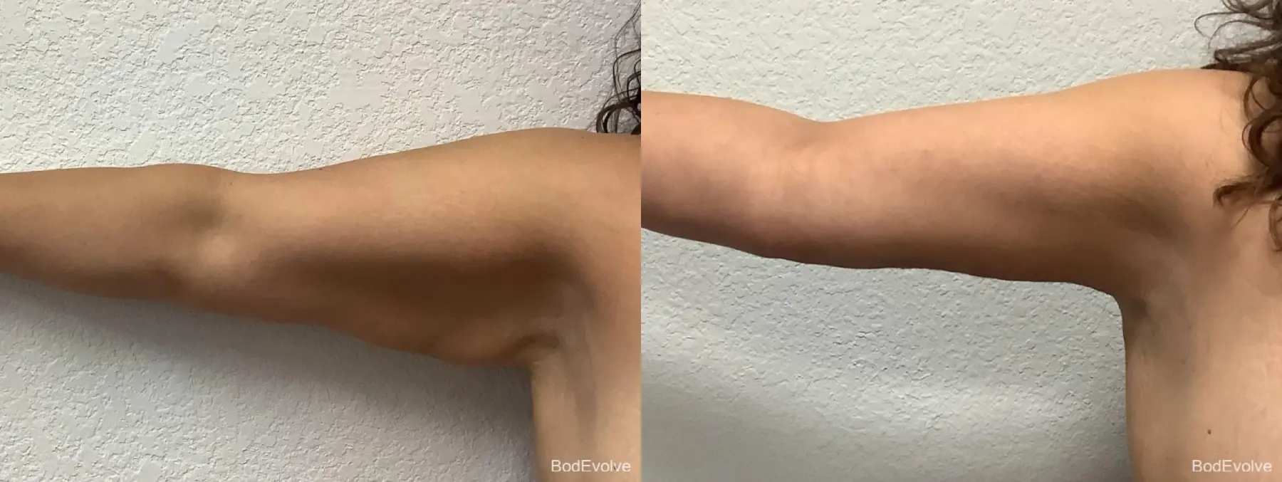 Arm Lift: Patient 4 - Before and After  