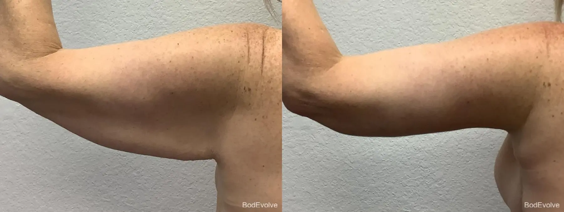 Arm Lift: Patient 6 - Before and After 2