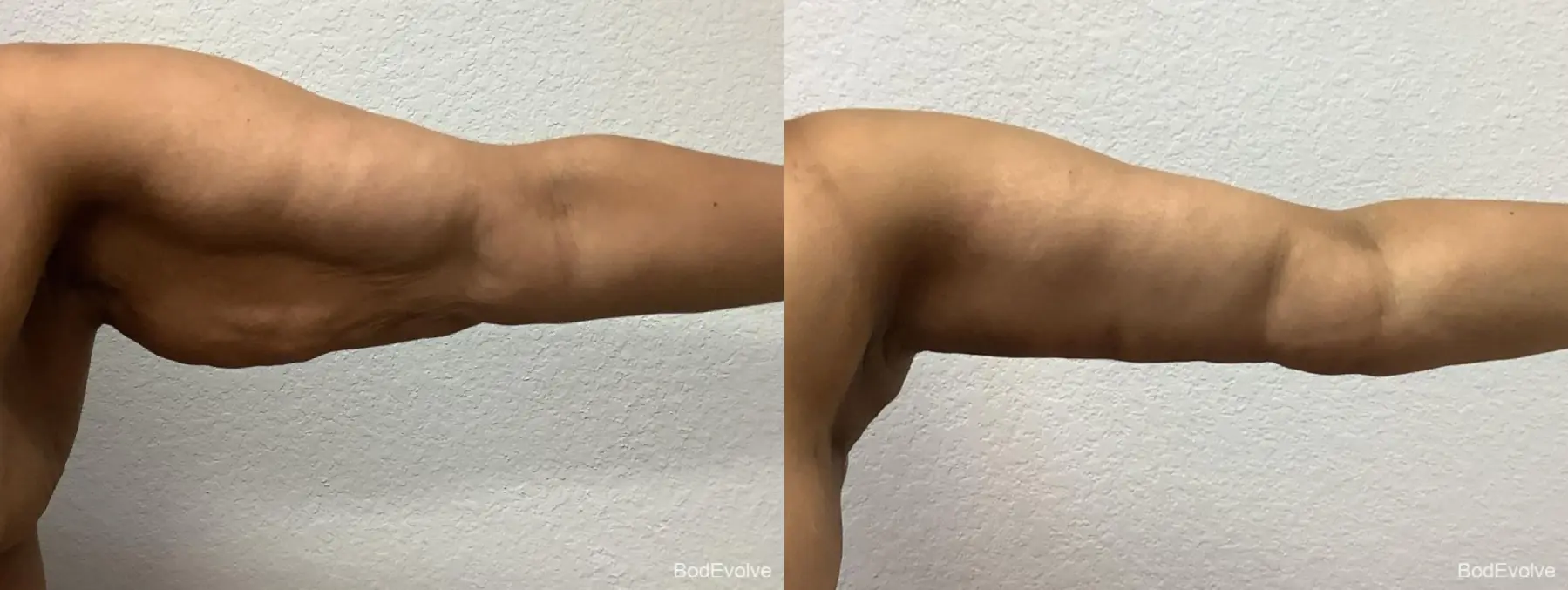 Arm Lift: Patient 5 - Before and After 6