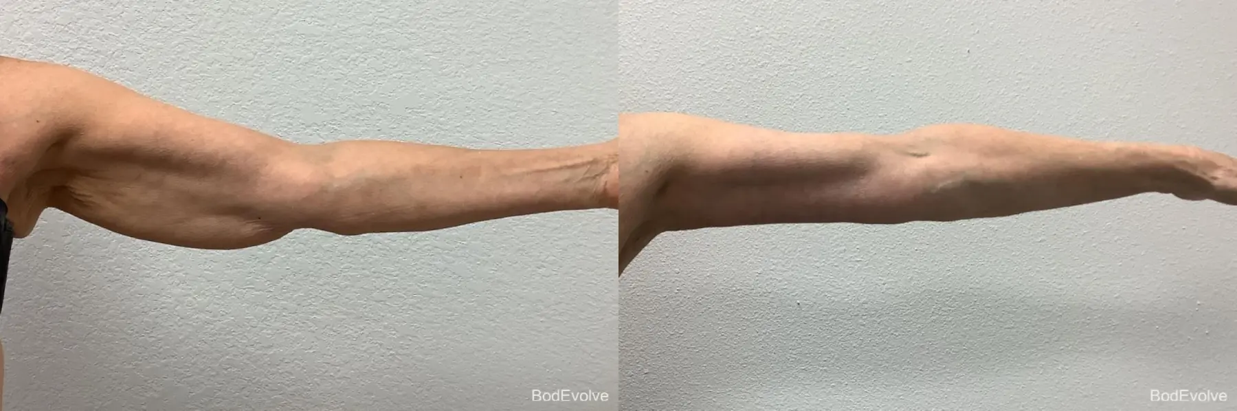 Arm Lift: Patient 5 - Before and After 5