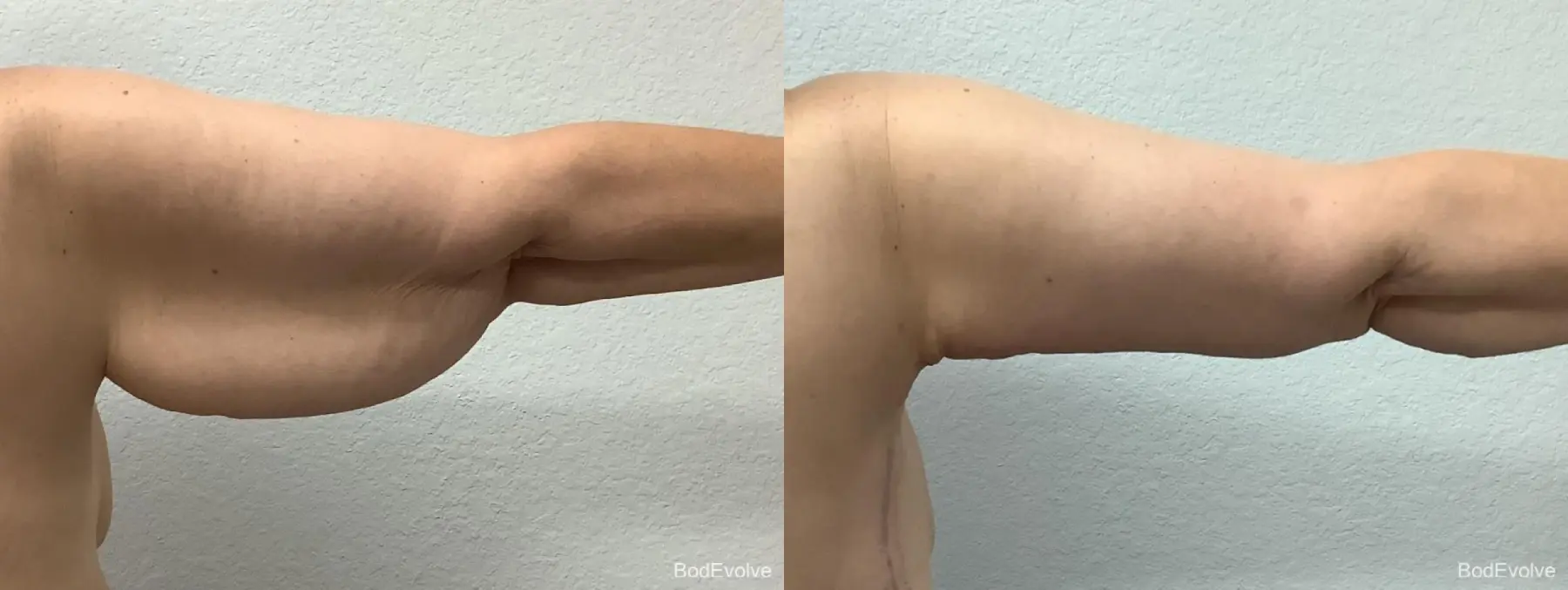 Arm Lift: Patient 1 - Before and After 5