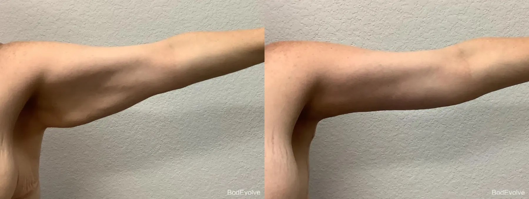 Arm Lift: Patient 6 - Before and After 7