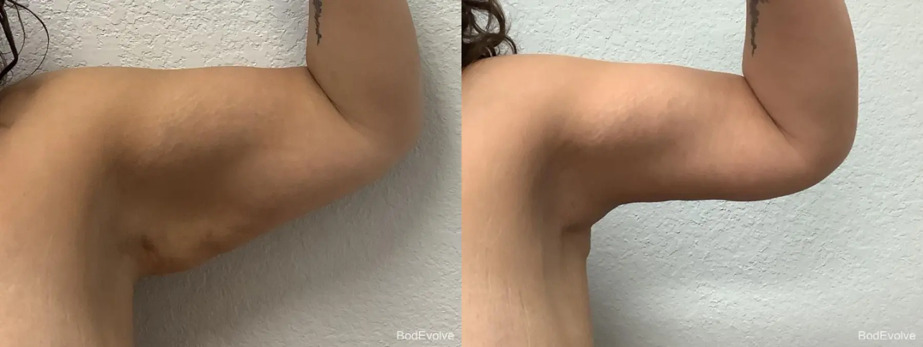 Arm Lift: Patient 4 - Before and After 5