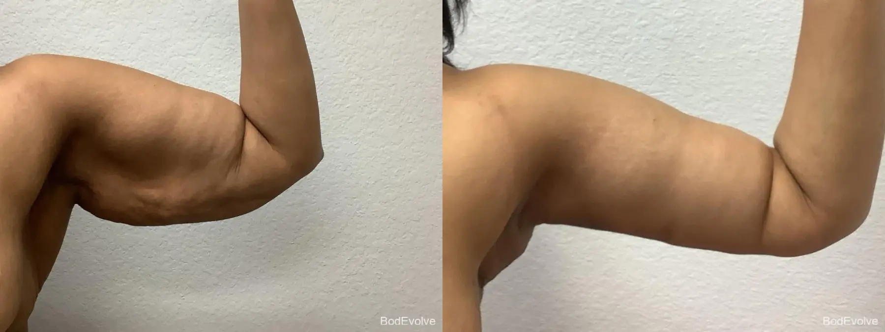 Arm Lift: Patient 5 - Before and After 5