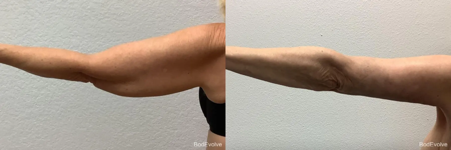 Arm Lift: Patient 5 - Before and After 2