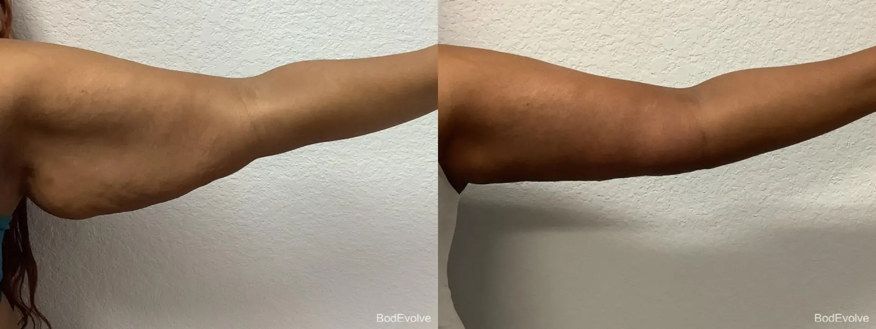 Arm Lift: Patient 2 - Before and After 4
