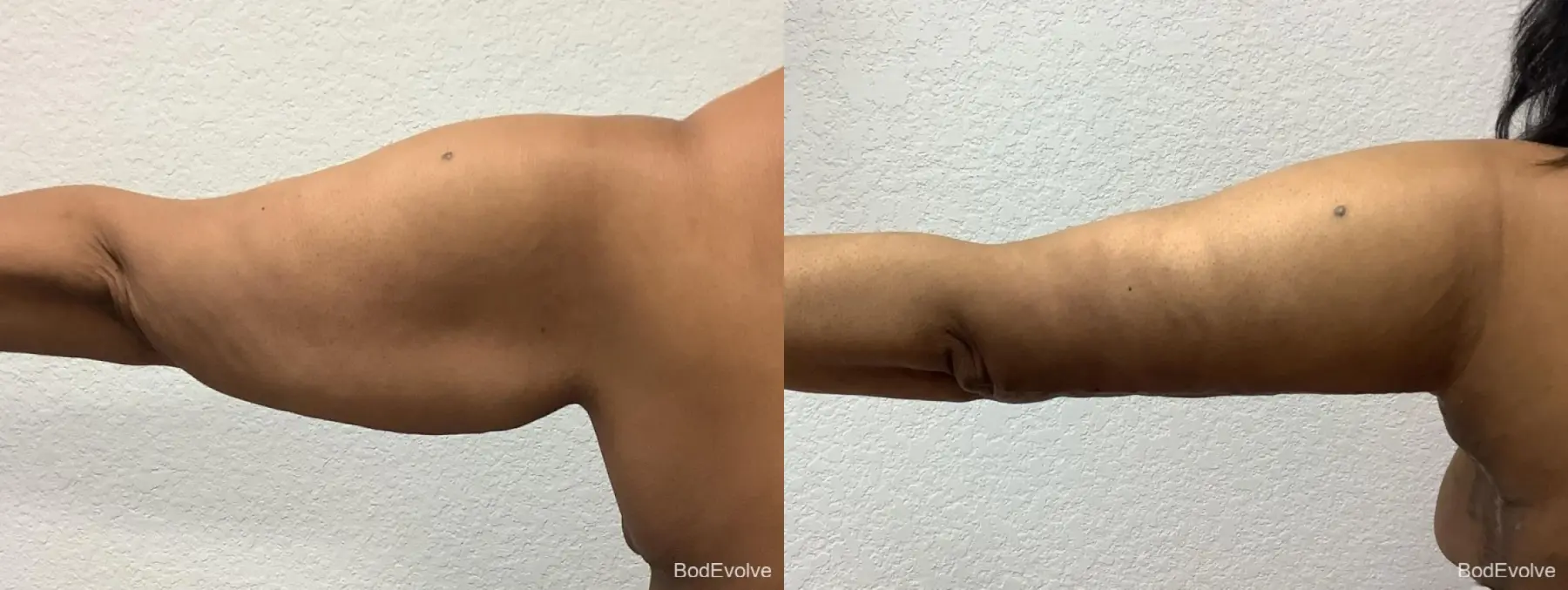 Arm Lift: Patient 5 - Before and After 3