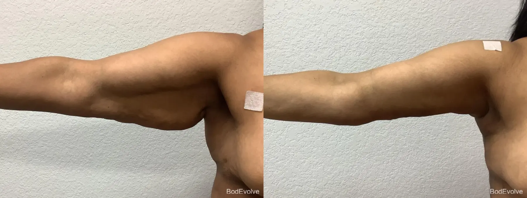 Arm Lift: Patient 4 - Before and After  