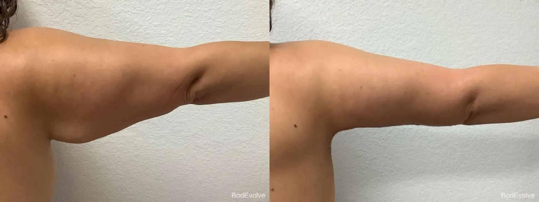 Arm Lift: Patient 4 - Before and After 4