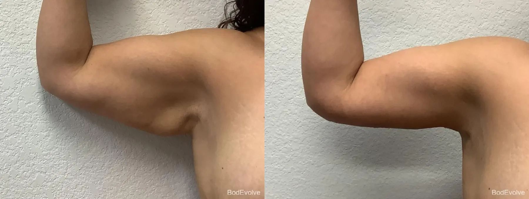 Arm Lift: Patient 4 - Before and After 2