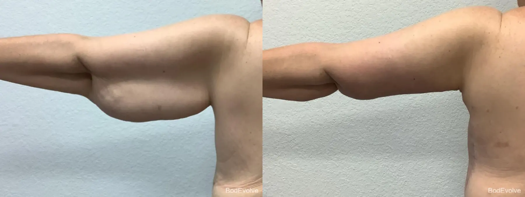 Arm Lift: Patient 1 - Before and After 7