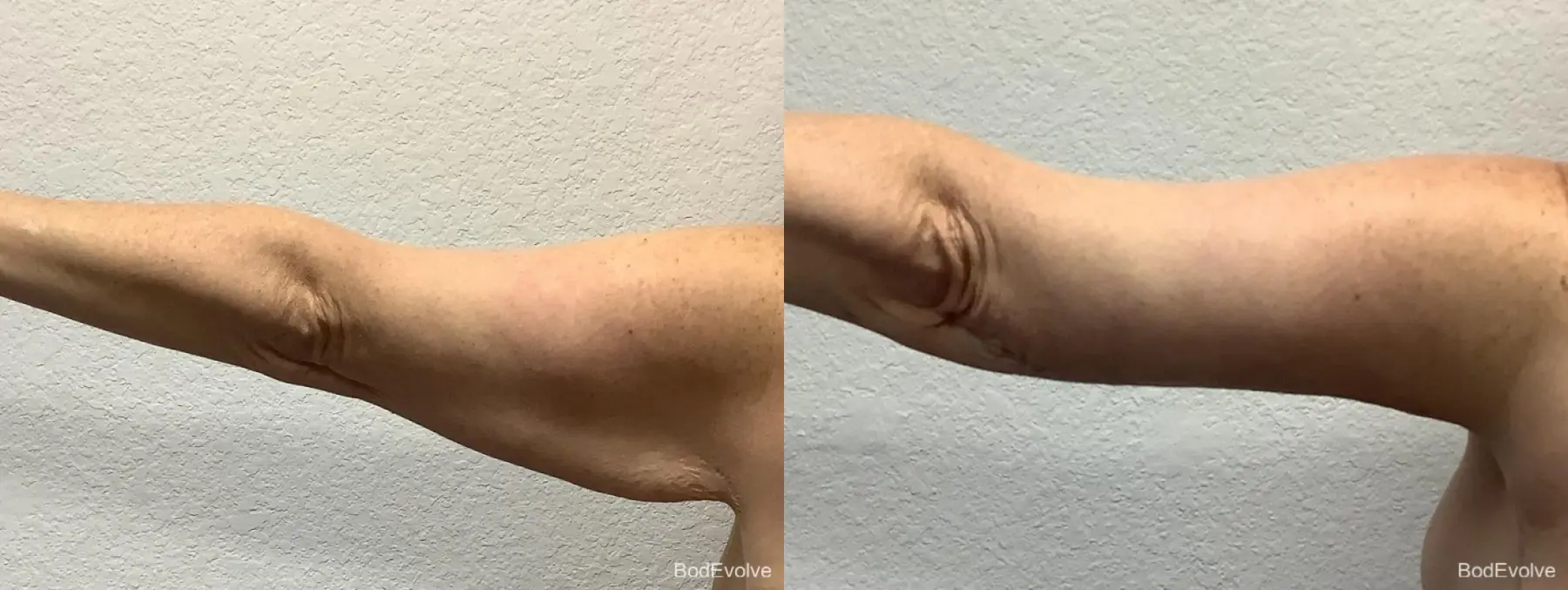 Arm Lift: Patient 6 - Before and After 3