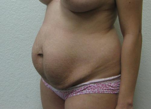 Tummy Tuck - Patient 12 - Before 2