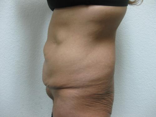 Patient 8 - Cosmetic Surgery After Massive Weight Loss - Before 4