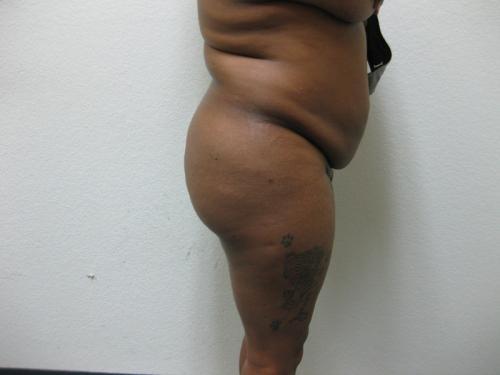 Brazilian Butt Lift - Patient 5 - Before and After 5