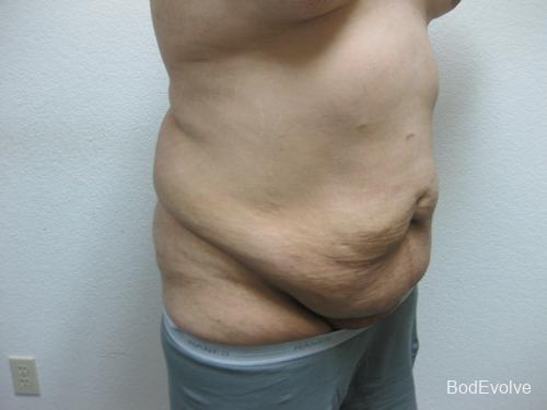 Patient 3 - Cosmetic Surgery After Massive Weight Loss - Before and After 8