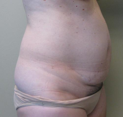 Tummy Tuck - Patient 6 - Before 3